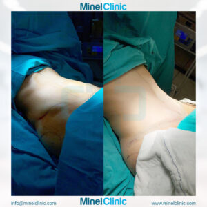 Tummy Tuck