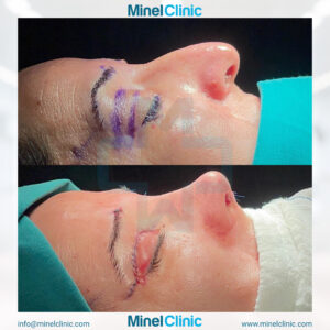 Blepharoplasty