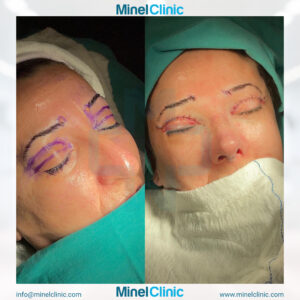 Blepharoplasty