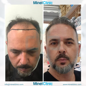 Hair Transplant