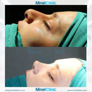 Rhinoplasty