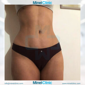 Liposuction