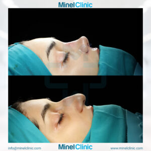 Rhinoplasty