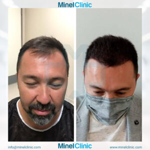 Hair Transplant