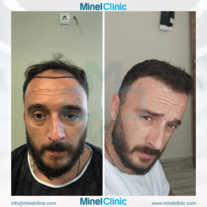 Hair Transplant