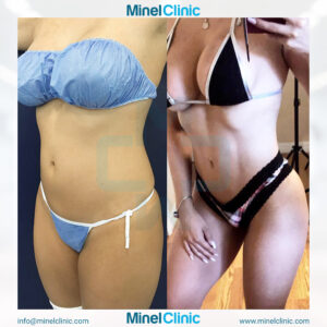 Liposuction