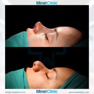 Rhinoplasty