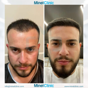 Hair Transplant