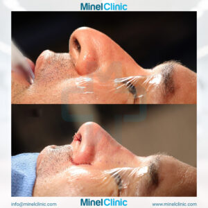 Rhinoplasty