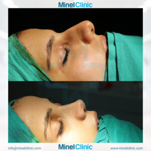 Rhinoplasty