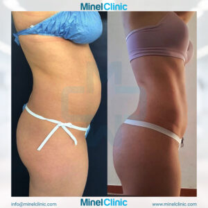 Liposuction