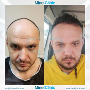 Hair Transplant