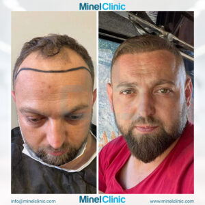 Hair Transplant