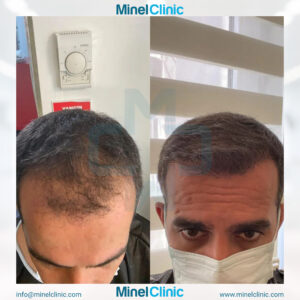 Hair Transplant