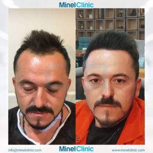 Hair Transplant