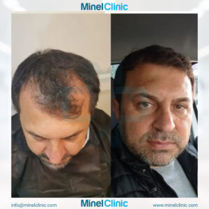 Hair Transplant