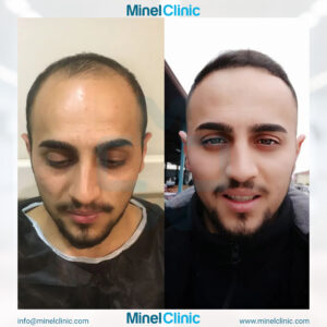 Hair Transplant