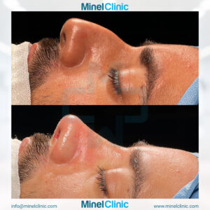 Rhinoplasty