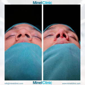 Rhinoplasty