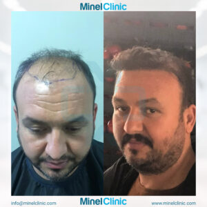 Hair Transplant