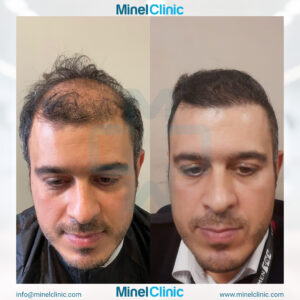 Hair Transplant