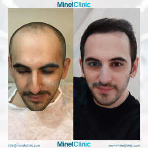 Hair Transplant