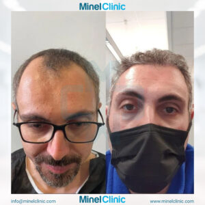 Hair Transplant