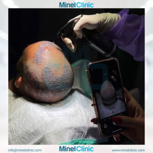 Hair Transplant