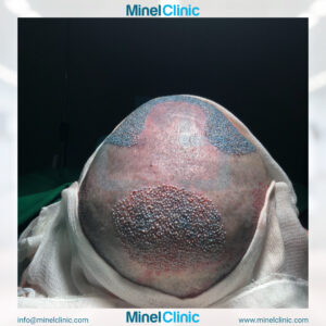 Hair Transplant