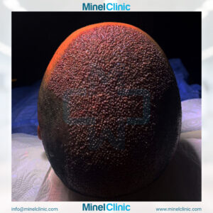 Hair Transplant