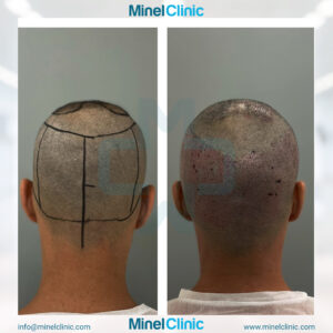 Hair Transplant