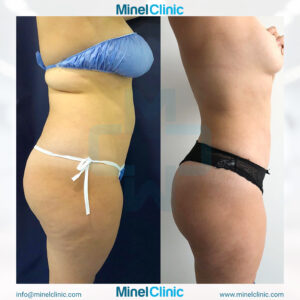 Liposuction